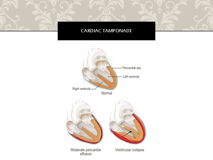 CARDIAC TAMPONADE 