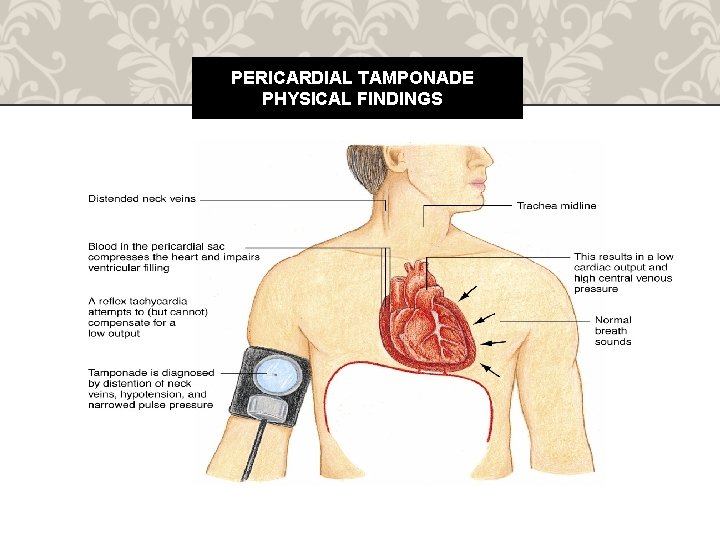 PERICARDIAL TAMPONADE PHYSICAL FINDINGS 