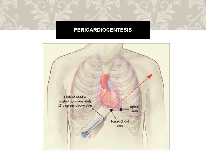 PERICARDIOCENTESIS 