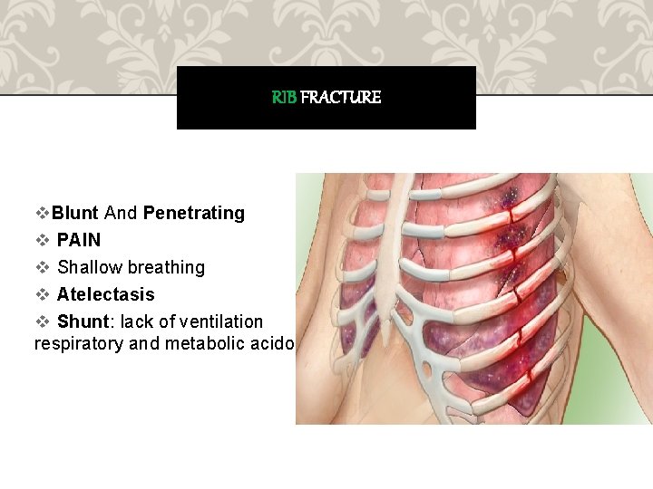 RIB FRACTURE v. Blunt And Penetrating v PAIN v Shallow breathing v Atelectasis v