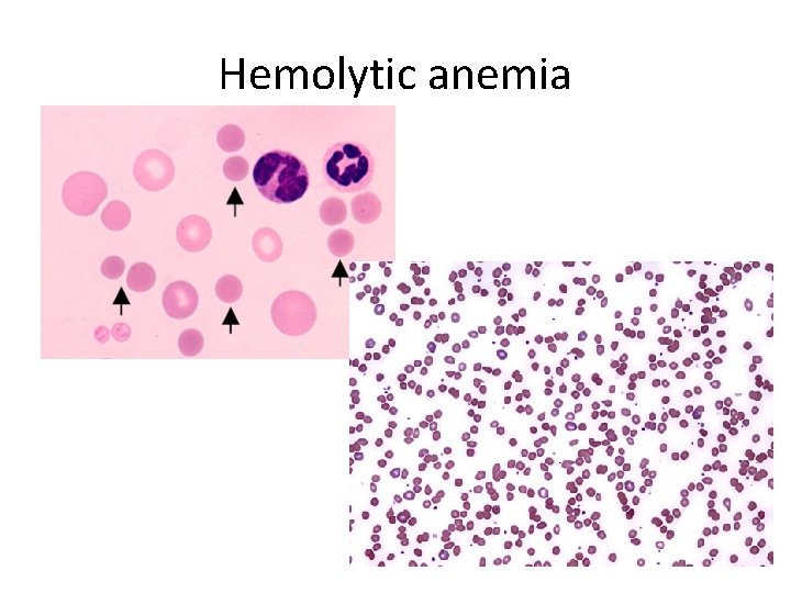 Hemolytic anemia 