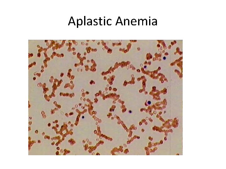 Aplastic Anemia 