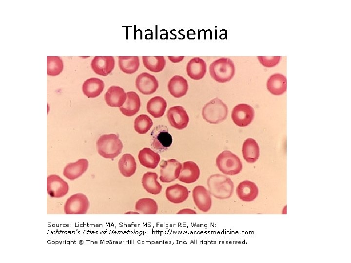 Thalassemia 