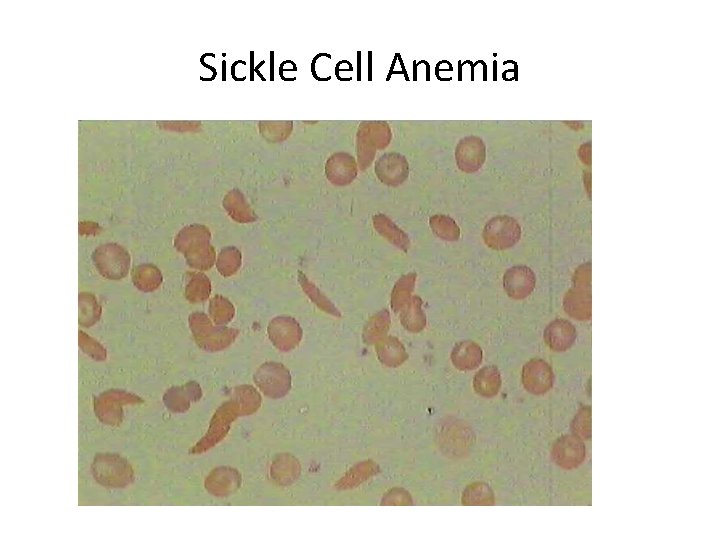 Sickle Cell Anemia 