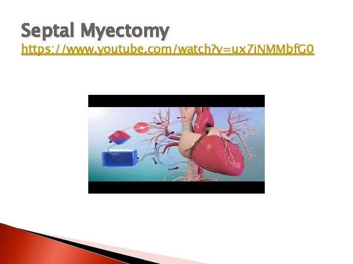 Septal Myectomy https: //www. youtube. com/watch? v=ux 7 i. NMMbf. G 0 