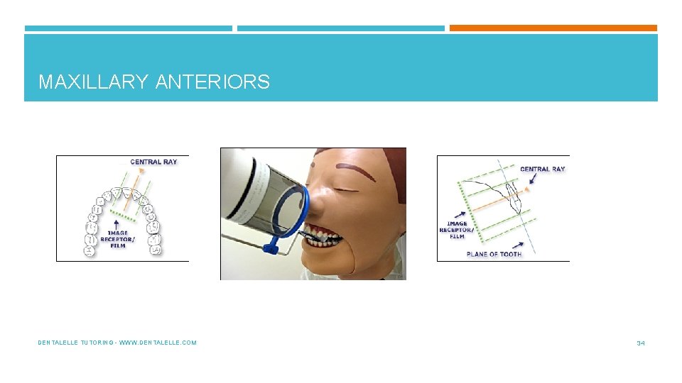 MAXILLARY ANTERIORS DENTALELLE TUTORING - WWW. DENTALELLE. COM 34 