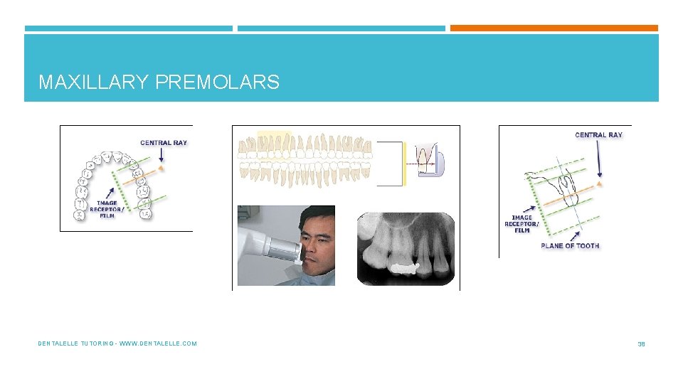 MAXILLARY PREMOLARS DENTALELLE TUTORING - WWW. DENTALELLE. COM 38 