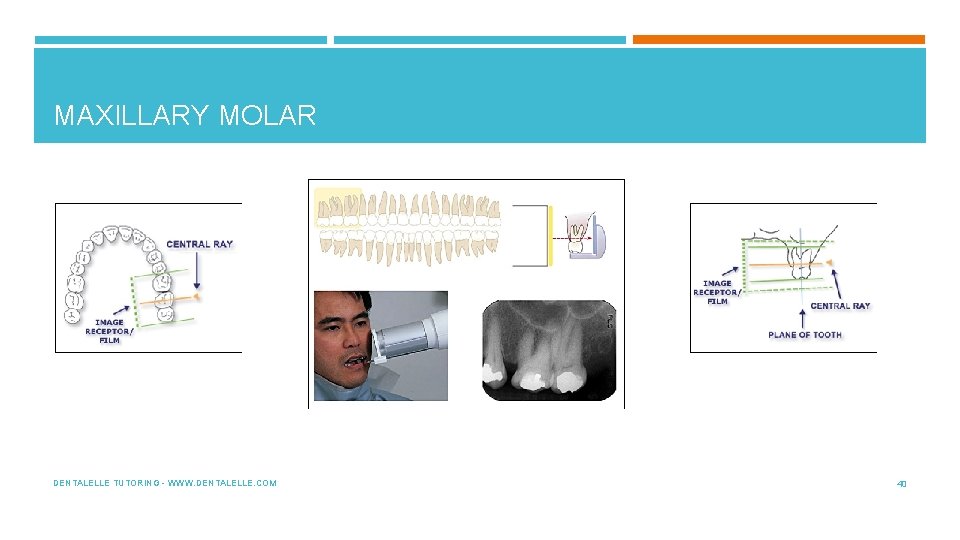 MAXILLARY MOLAR DENTALELLE TUTORING - WWW. DENTALELLE. COM 40 