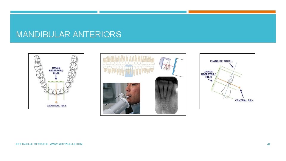 MANDIBULAR ANTERIORS DENTALELLE TUTORING - WWW. DENTALELLE. COM 42 