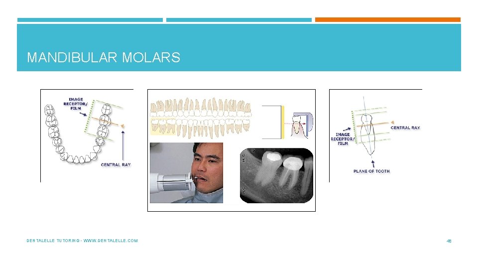 MANDIBULAR MOLARS DENTALELLE TUTORING - WWW. DENTALELLE. COM 48 