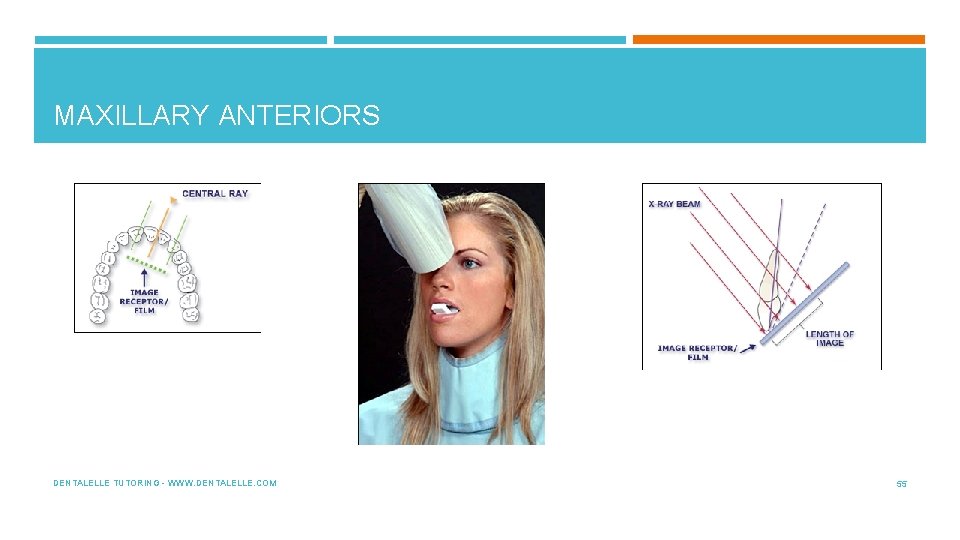 MAXILLARY ANTERIORS DENTALELLE TUTORING - WWW. DENTALELLE. COM 55 