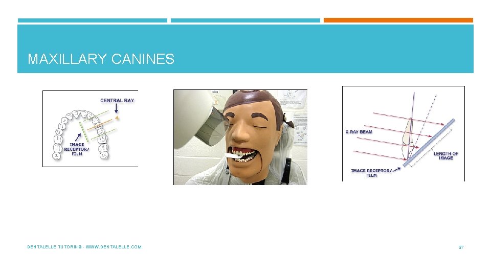 MAXILLARY CANINES DENTALELLE TUTORING - WWW. DENTALELLE. COM 57 