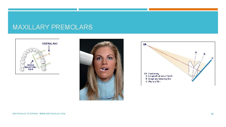 MAXILLARY PREMOLARS DENTALELLE TUTORING - WWW. DENTALELLE. COM 59 