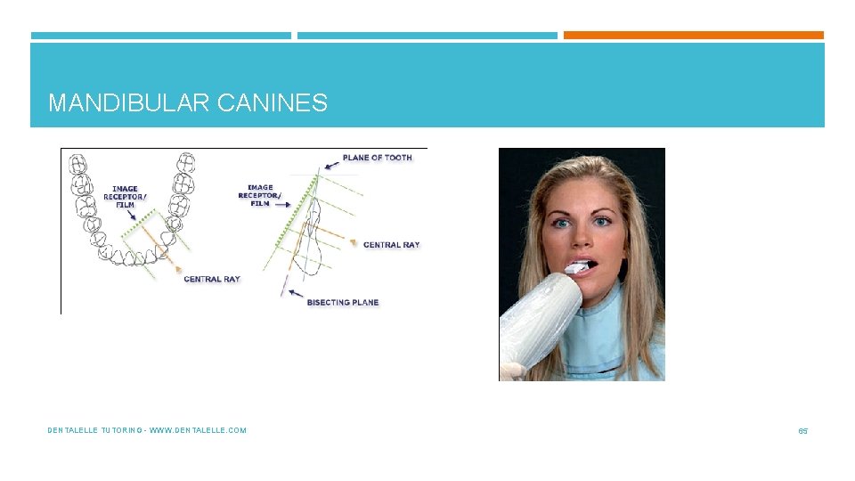 MANDIBULAR CANINES DENTALELLE TUTORING - WWW. DENTALELLE. COM 65 