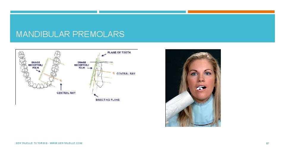 MANDIBULAR PREMOLARS DENTALELLE TUTORING - WWW. DENTALELLE. COM 67 