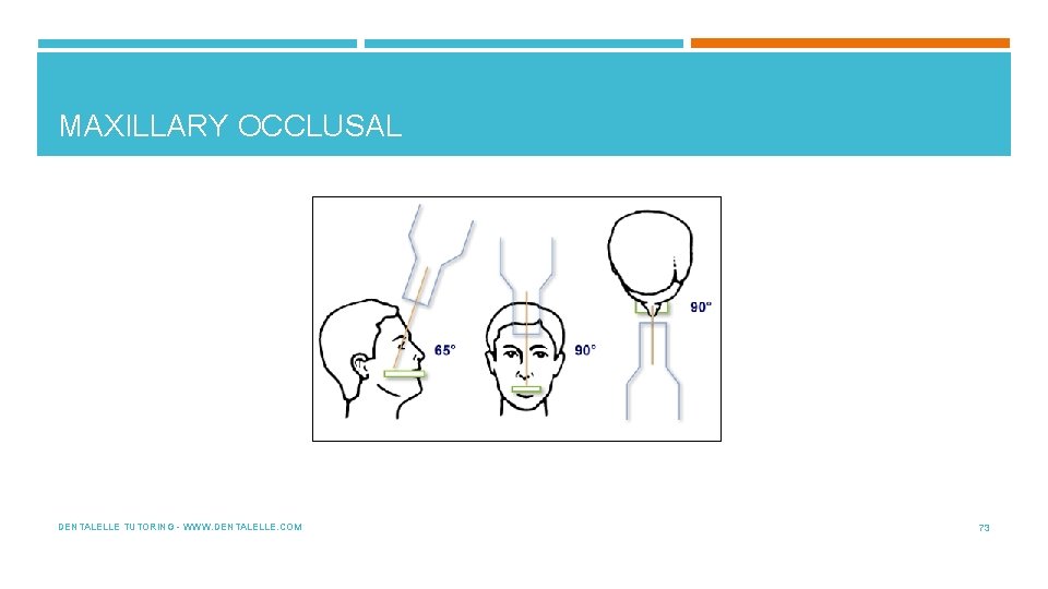 MAXILLARY OCCLUSAL DENTALELLE TUTORING - WWW. DENTALELLE. COM 73 