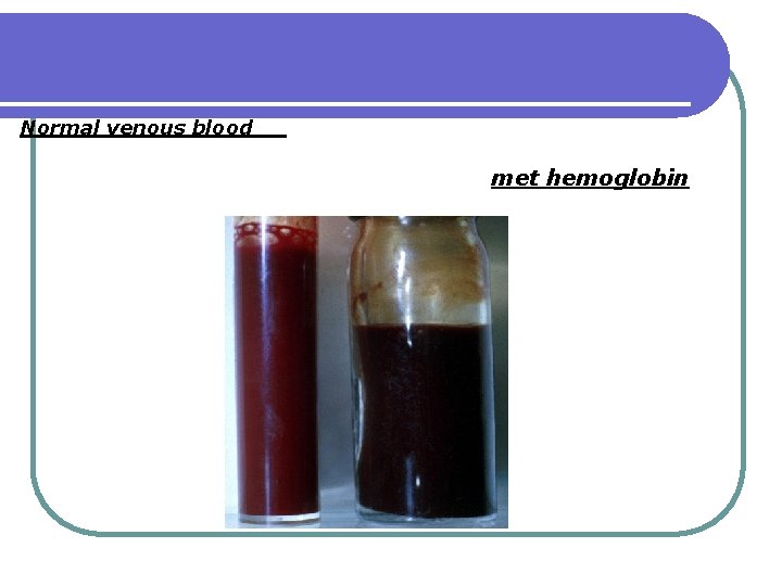 Normal venous blood met hemoglobin 