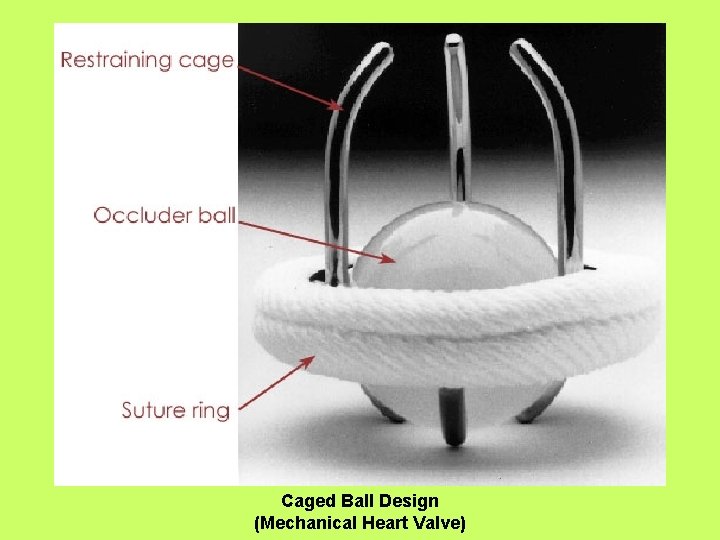 Caged Ball Design (Mechanical Heart Valve) 