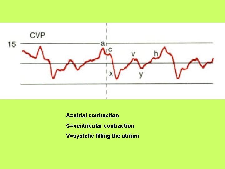 A=atrial contraction C=ventricular contraction V=systolic filling the atrium 