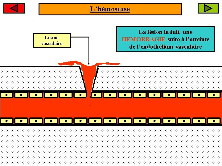L’hémostase Lésion vasculaire La lésion induit une HEMORRAGIE suite à l’atteinte de l’endothélium vasculaire
