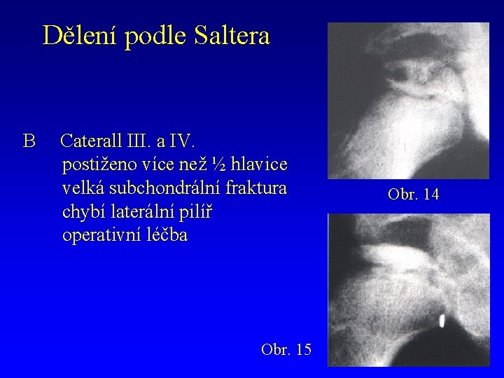 Dělení podle Saltera B Caterall III. a IV. postiženo více než ½ hlavice velká