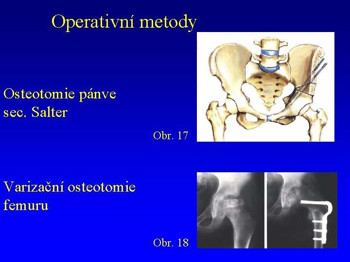 Operativní metody Osteotomie pánve sec. Salter Obr. 17 Varizační osteotomie femuru Obr. 18 
