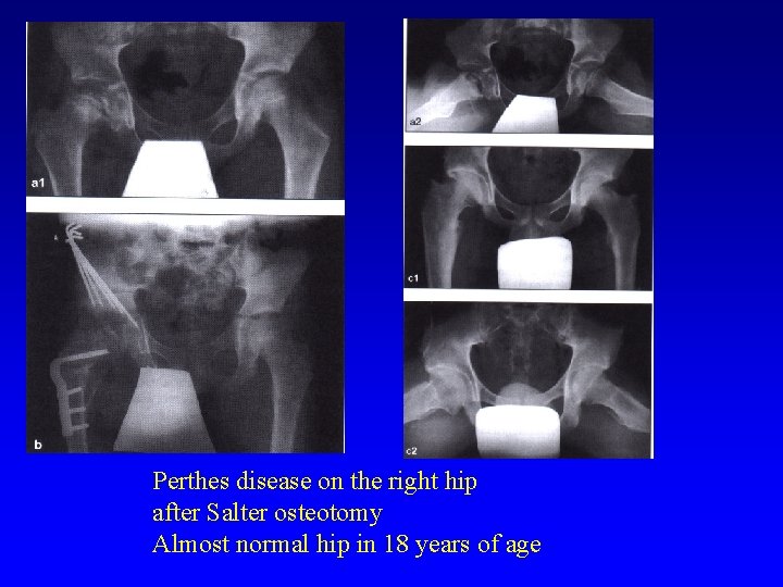 Perthes disease on the right hip after Salter osteotomy Almost normal hip in 18