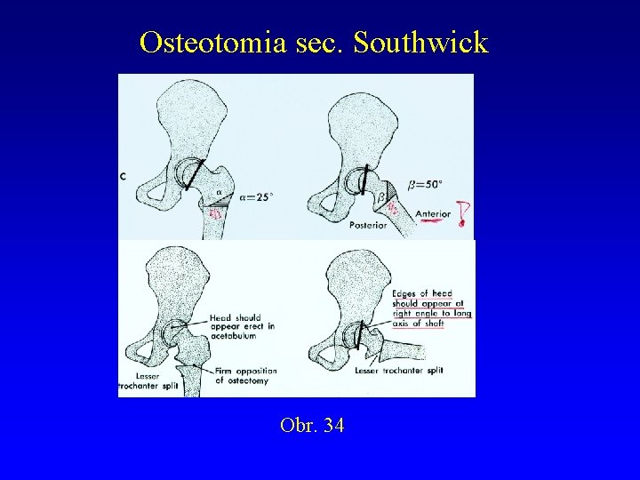 Osteotomia sec. Southwick Obr. 34 