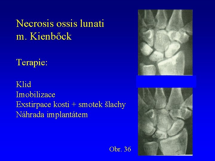 Necrosis ossis lunati m. Kienbőck Terapie: Klid Imobilizace Exstirpace kosti + smotek šlachy Náhrada