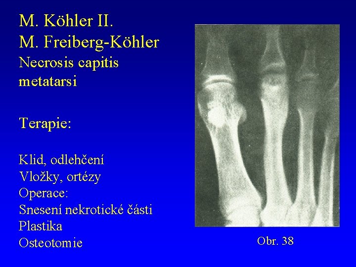 M. Köhler II. M. Freiberg-Köhler Necrosis capitis metatarsi Terapie: Klid, odlehčení Vložky, ortézy Operace: