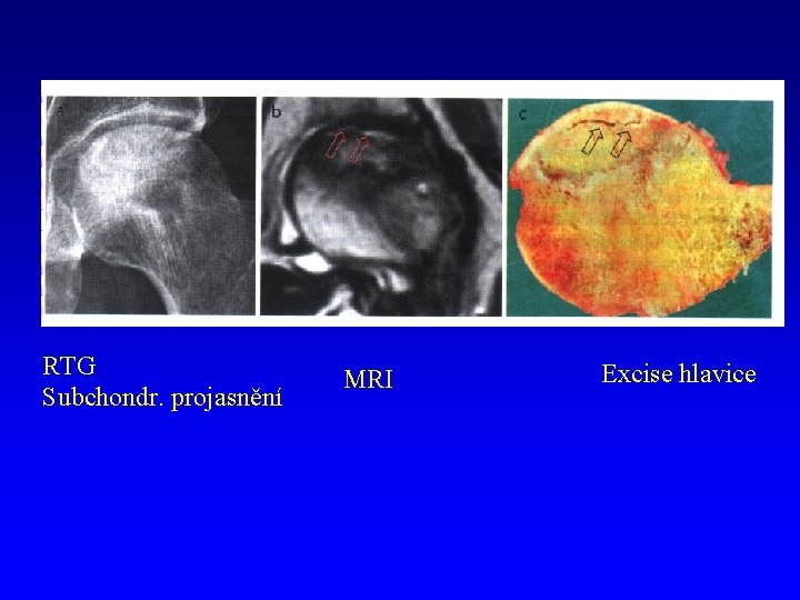 RTG Subchondr. projasnění MRI Excise hlavice 