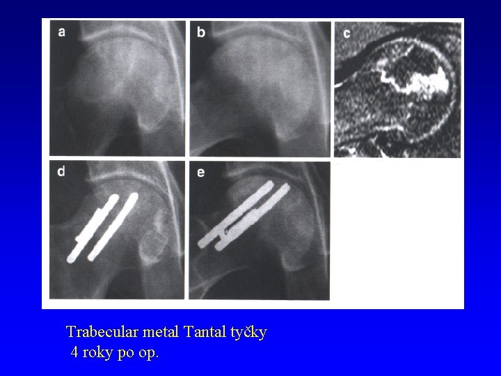 Trabecular metal Tantal tyčky 4 roky po op. 