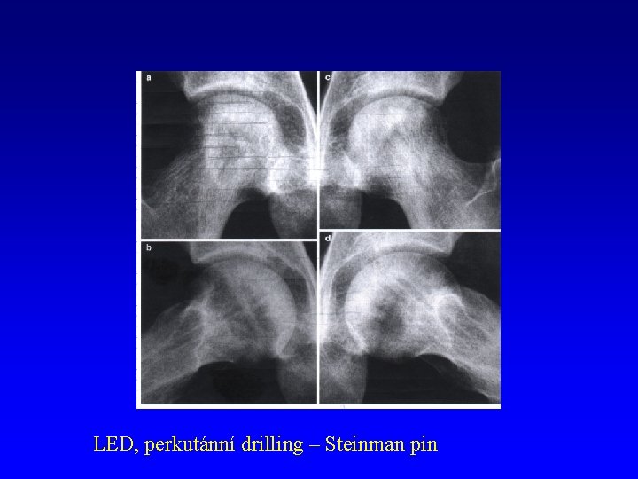 LED, perkutánní drilling – Steinman pin 