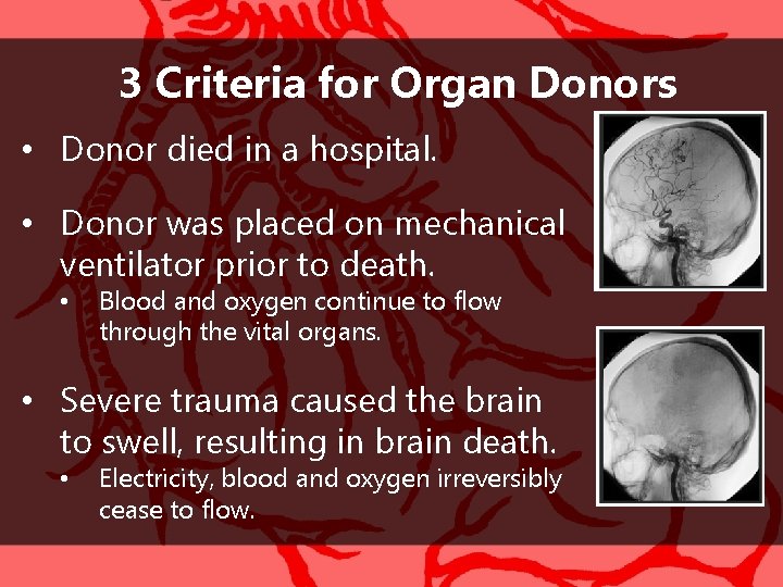 3 Criteria for Organ Donors • Donor died in a hospital. • Donor was