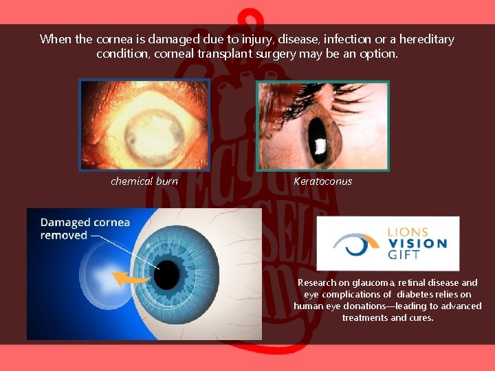 When the cornea is damaged due to injury, disease, infection or a hereditary condition,