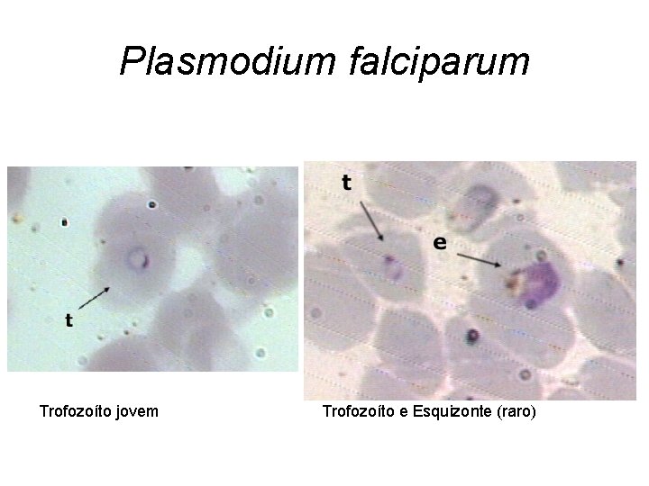 Plasmodium falciparum Trofozoíto jovem Trofozoíto e Esquizonte (raro) 