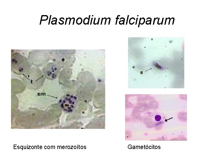Plasmodium falciparum Esquizonte com merozoítos Gametócitos 