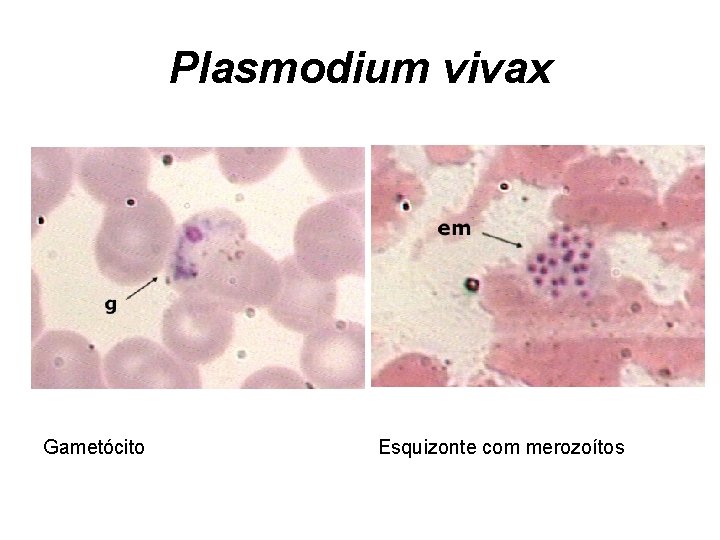 Plasmodium vivax Gametócito Esquizonte com merozoítos 