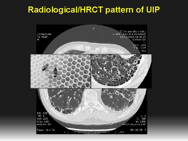 Terapia della fibrosi polmonare idiopatica Paolo Spagnolo Clinica