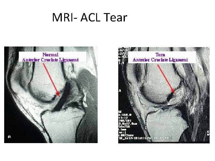 MRI- ACL Tear 
