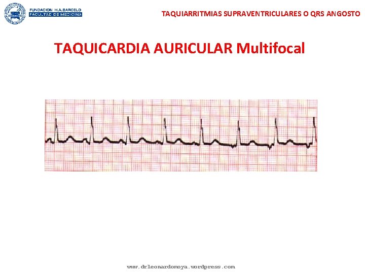 TAQUIARRITMIAS SUPRAVENTRICULARES O QRS ANGOSTO TAQUICARDIA AURICULAR Multifocal www. drleonardomoya. wordpress. com 