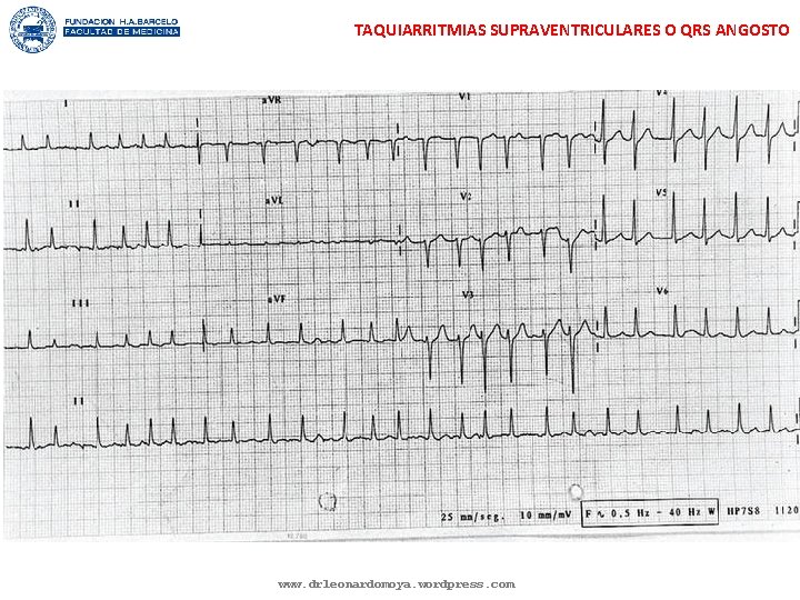 TAQUIARRITMIAS SUPRAVENTRICULARES O QRS ANGOSTO www. drleonardomoya. wordpress. com 