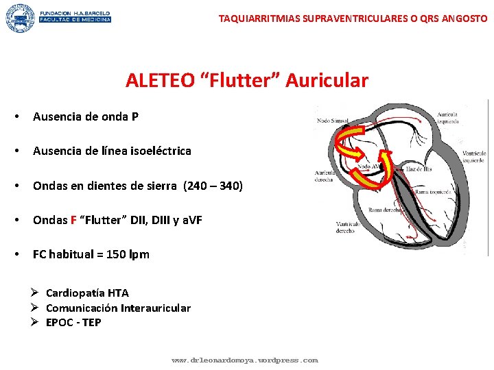 TAQUIARRITMIAS SUPRAVENTRICULARES O QRS ANGOSTO ALETEO “Flutter” Auricular • Ausencia de onda P • TAQUIARRITMIAS SUPRAVENTRICULARES O QRS ANGOSTO ALETEO “Flutter” Auricular • Ausencia de onda P •