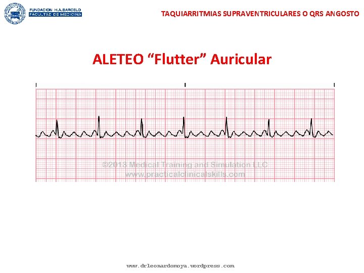 TAQUIARRITMIAS SUPRAVENTRICULARES O QRS ANGOSTO ALETEO “Flutter” Auricular www. drleonardomoya. wordpress. com 