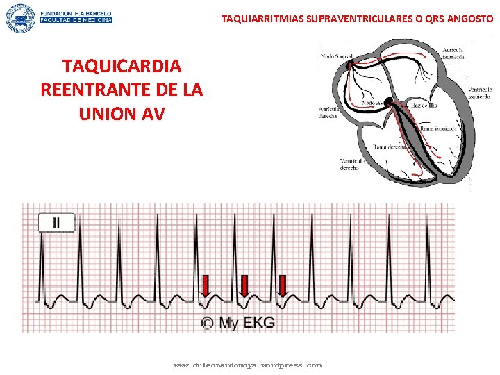 TAQUIARRITMIAS SUPRAVENTRICULARES O QRS ANGOSTO TAQUICARDIA REENTRANTE DE LA UNION AV www. drleonardomoya. wordpress.