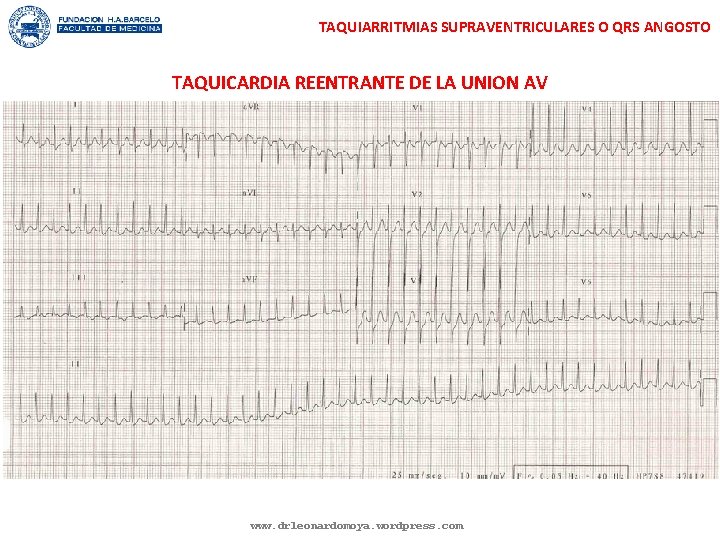 TAQUIARRITMIAS SUPRAVENTRICULARES O QRS ANGOSTO TAQUICARDIA REENTRANTE DE LA UNION AV www. drleonardomoya. wordpress.