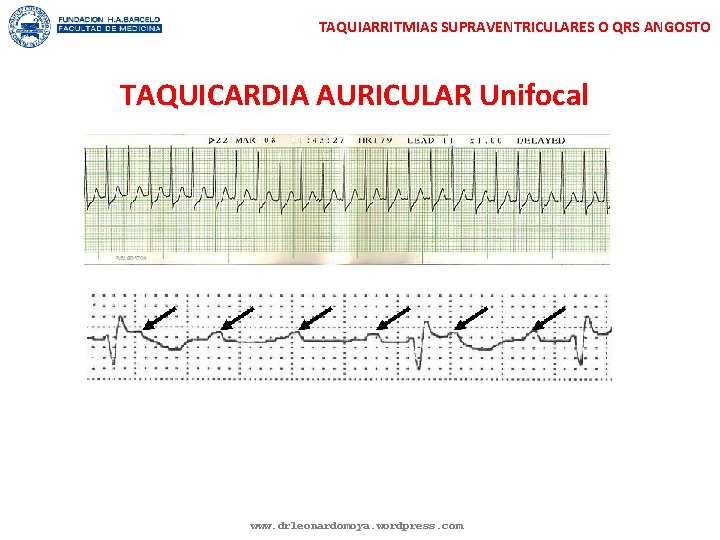 TAQUIARRITMIAS SUPRAVENTRICULARES O QRS ANGOSTO TAQUICARDIA AURICULAR Unifocal www. drleonardomoya. wordpress. com 