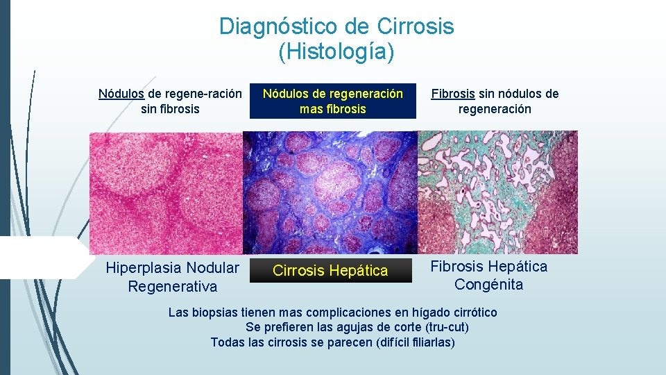 Diagnóstico de Cirrosis (Histología) Nódulos de regene-ración sin fibrosis Nódulos de regeneración mas fibrosis