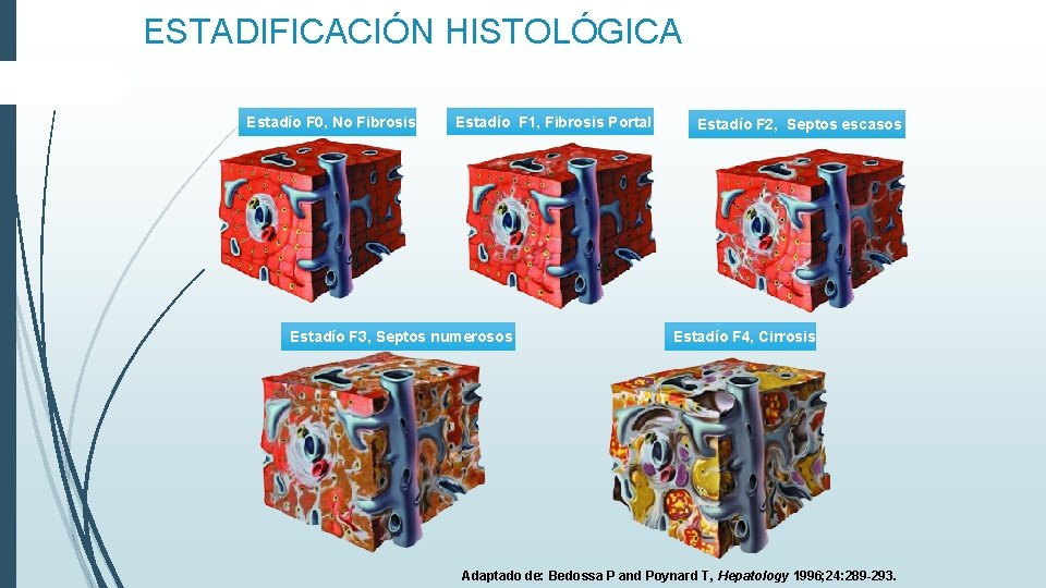 ESTADIFICACIÓN HISTOLÓGICA Estadío F 0, No Fibrosis Estadío F 1, Fibrosis Portal Estadío F