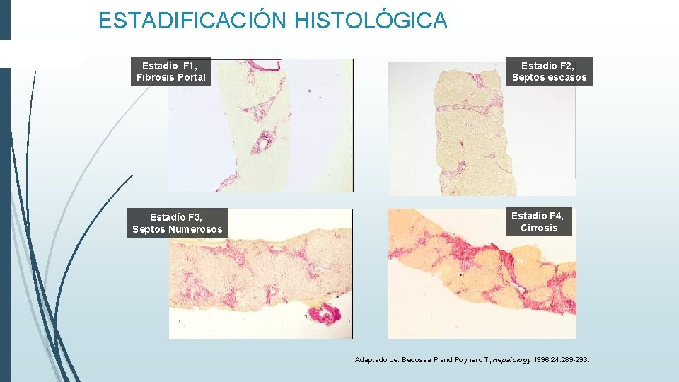 ESTADIFICACIÓN HISTOLÓGICA Estadío F 1, Fibrosis Portal Estadío F 3, Septos Numerosos Estadío F